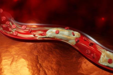 4 skriti znaki zamašenih arterij